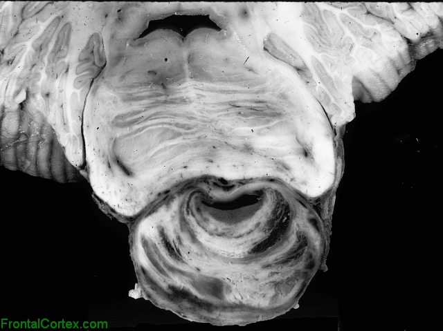 Thrombosed Basilar artery aneurysm, transverse section through pons